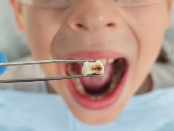 Best Emergency Dentist for Knocked-Out Tooth in Halsey, OR